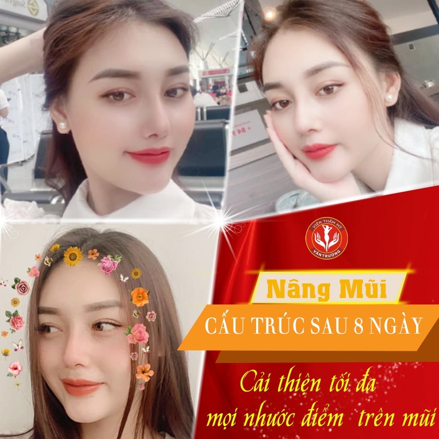 nâng mũi đẹp