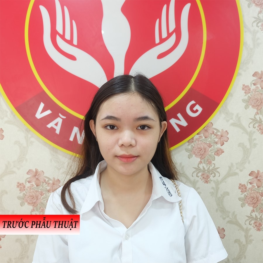 trước nâng mũi