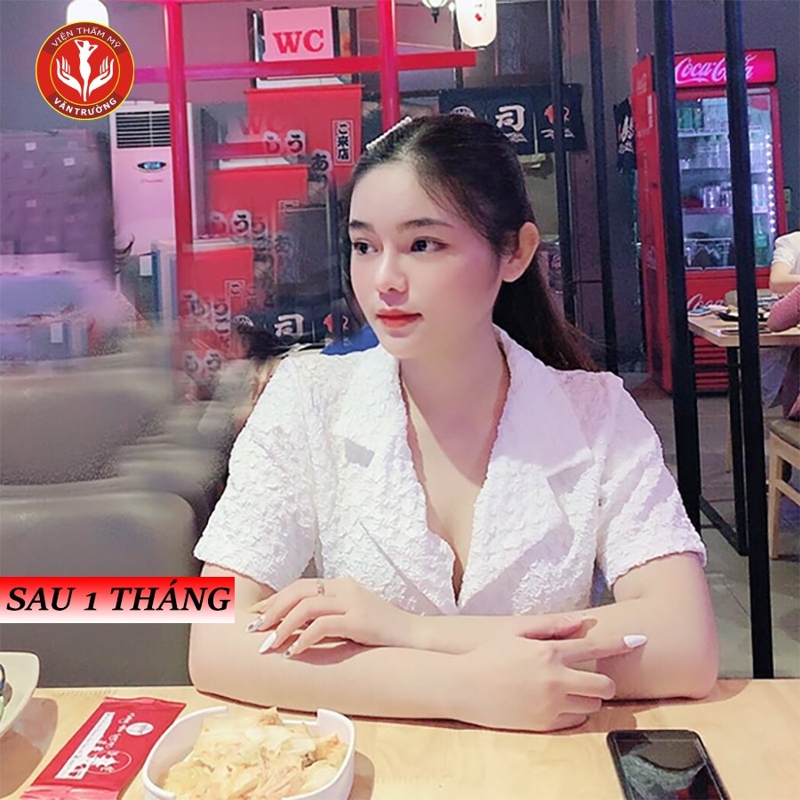 sau nâng mũi đẹp