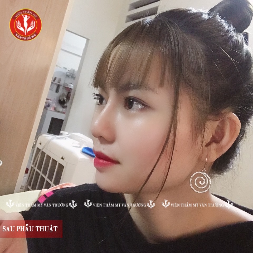 mũi đẹp sau nâng