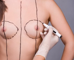 Nâng ngực nội soi qua nếp lằn vú