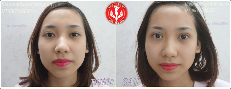 Bấm mí mắt đẹp ở tại Đà Nẵng 2