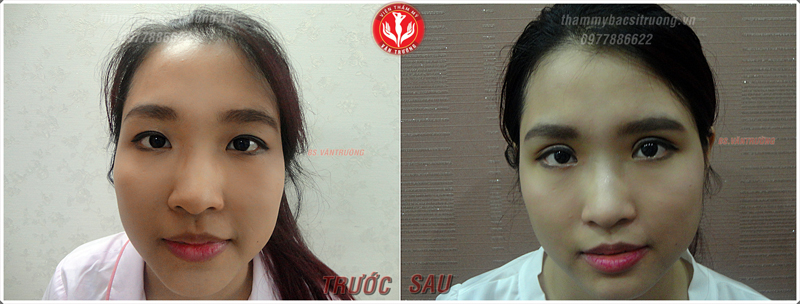 Bấm mí mắt đẹp ở tại Đà Nẵng 3