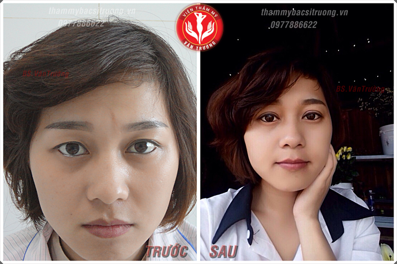 Bấm mí mắt đẹp ở tại Đà Nẵng 4