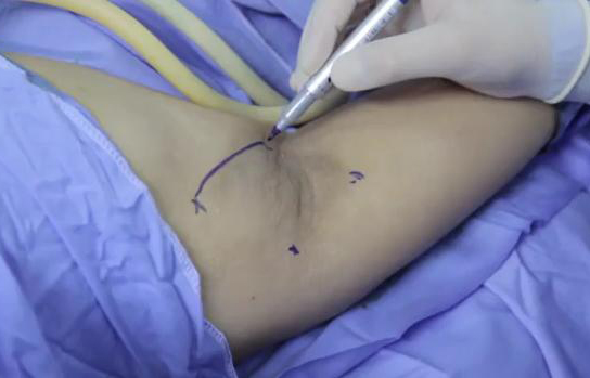 Triệt hôi nách hiệu quả