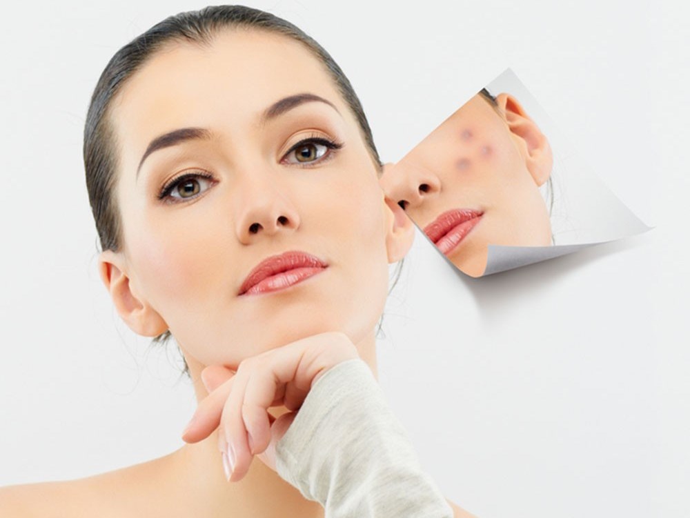 Điều trị mụn hiệu quả