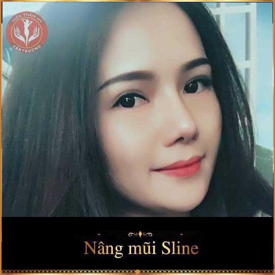 Nâng mũi s-line cấu trúc 1