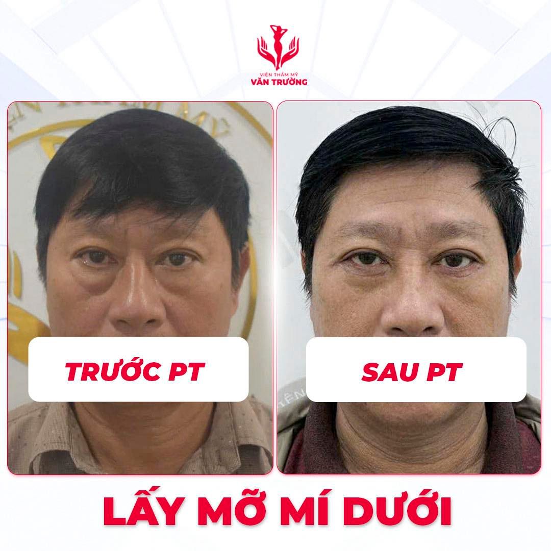 Lấy da thừa, mỡ thừa mi dưới