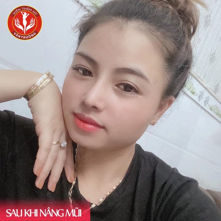 Nâng mũi S-line đẹp ở Đà Nẵng 3