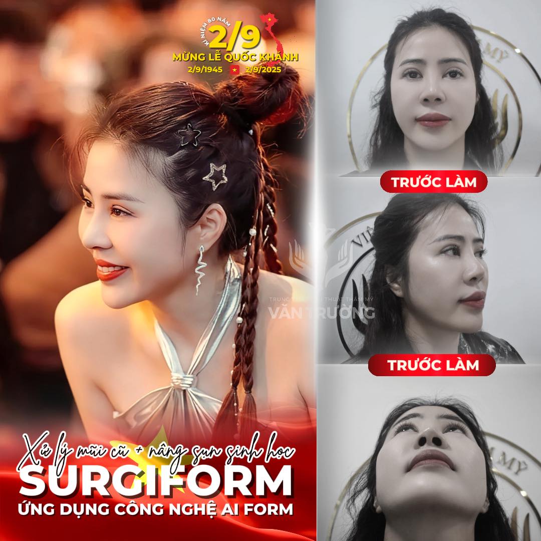 NÂNG MŨI SỤN SINH HỌC SURGIFORM 3