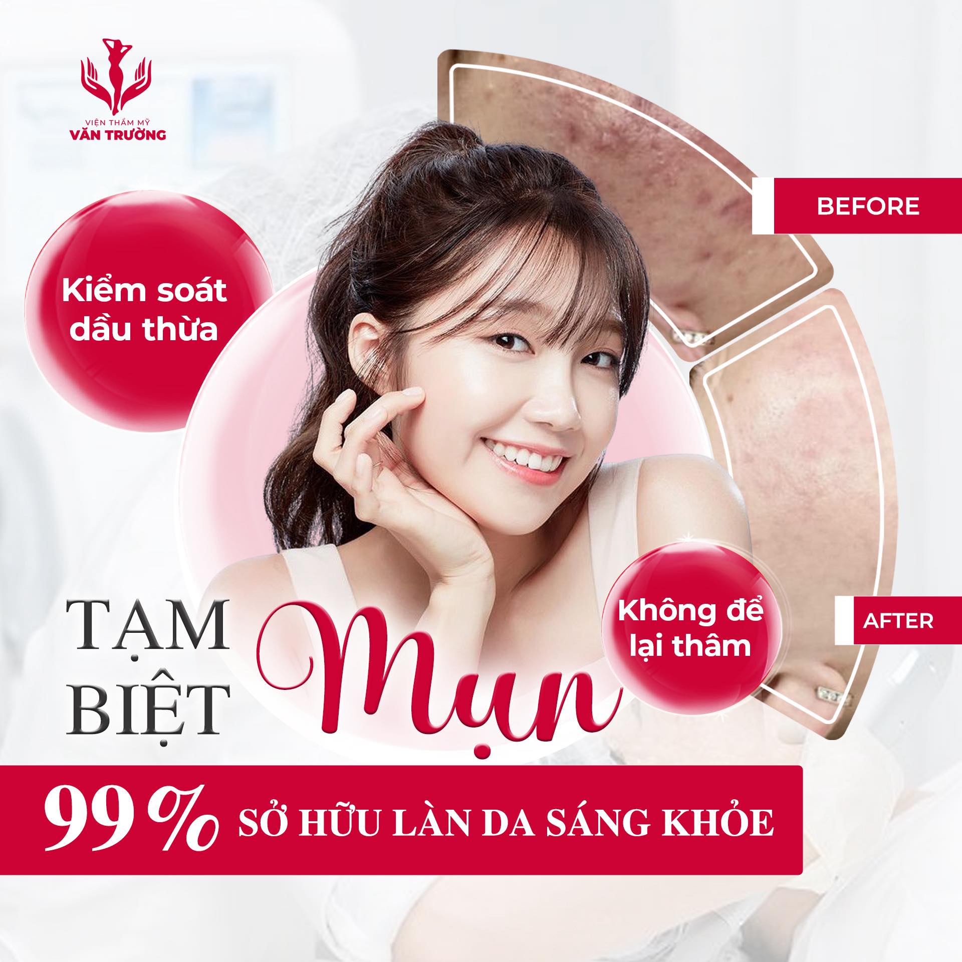 Điều trị mụn hiệu quả