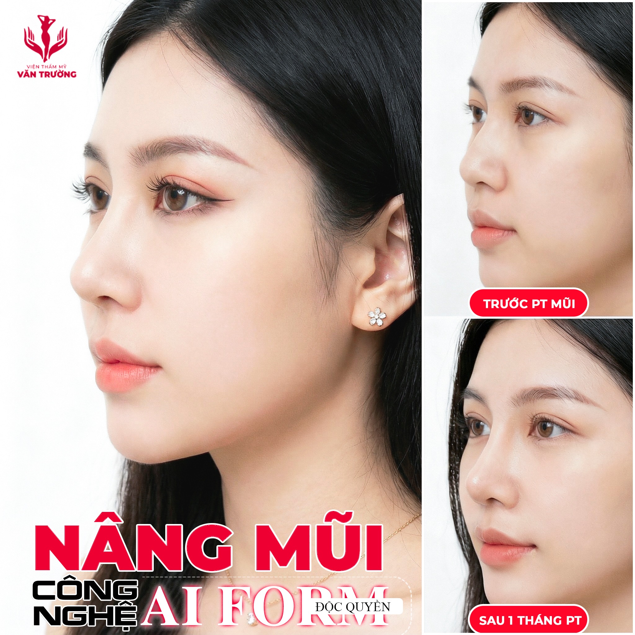 NÂNG MŨI CẤU TRÚC AI FORM 2