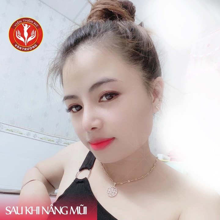 Nâng mũi bán cấu trúc đẹp tại đà nẵng 3