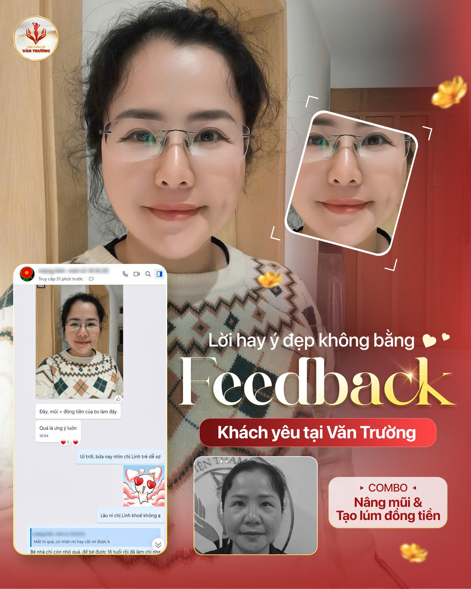 phản hồi nâng mũi