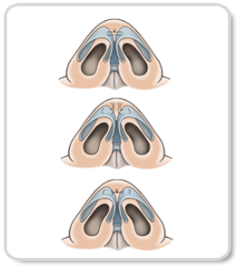 nâng mũi hàn quốc