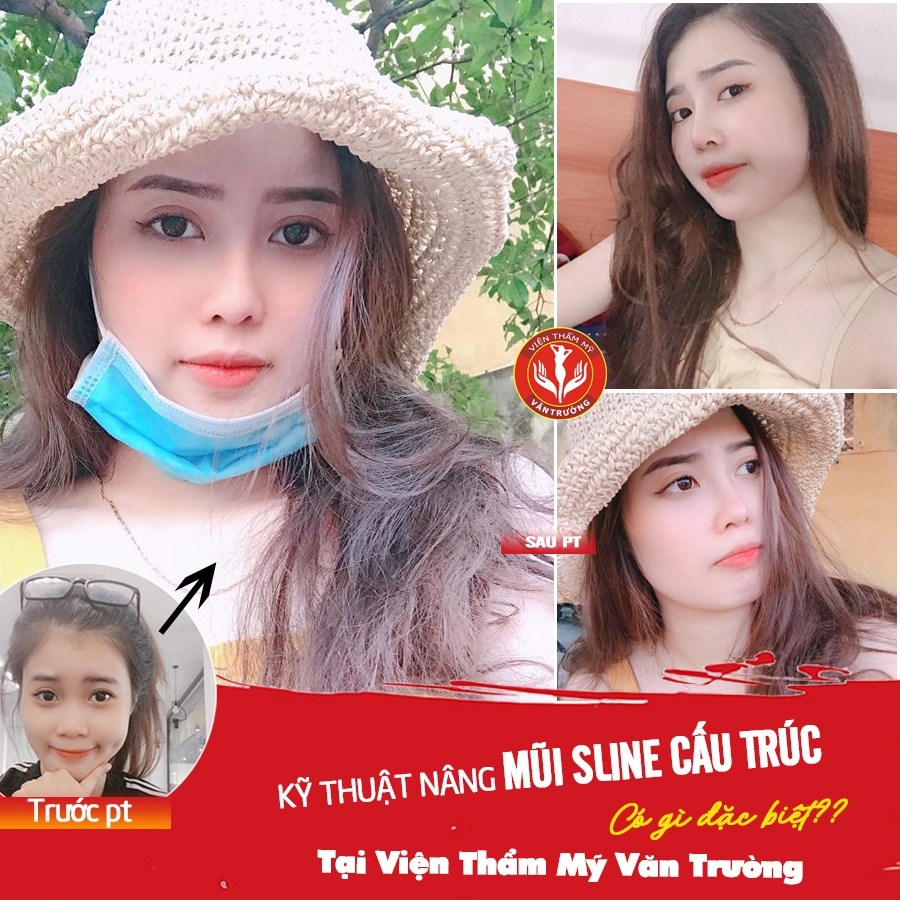 Nâng mũi S-line đẹp ở Đà Nẵng