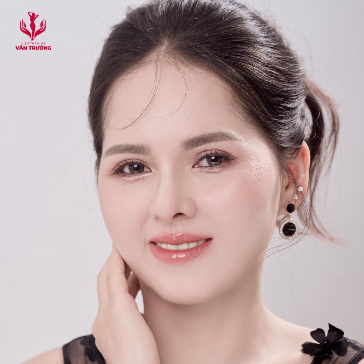 nâng mũi bs Trường 3