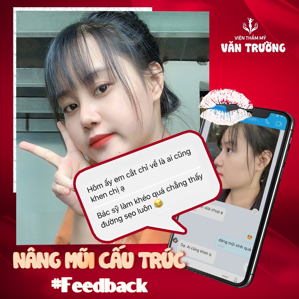 Nâng mũi cấu trúc đẹp tại đà nẵng 4