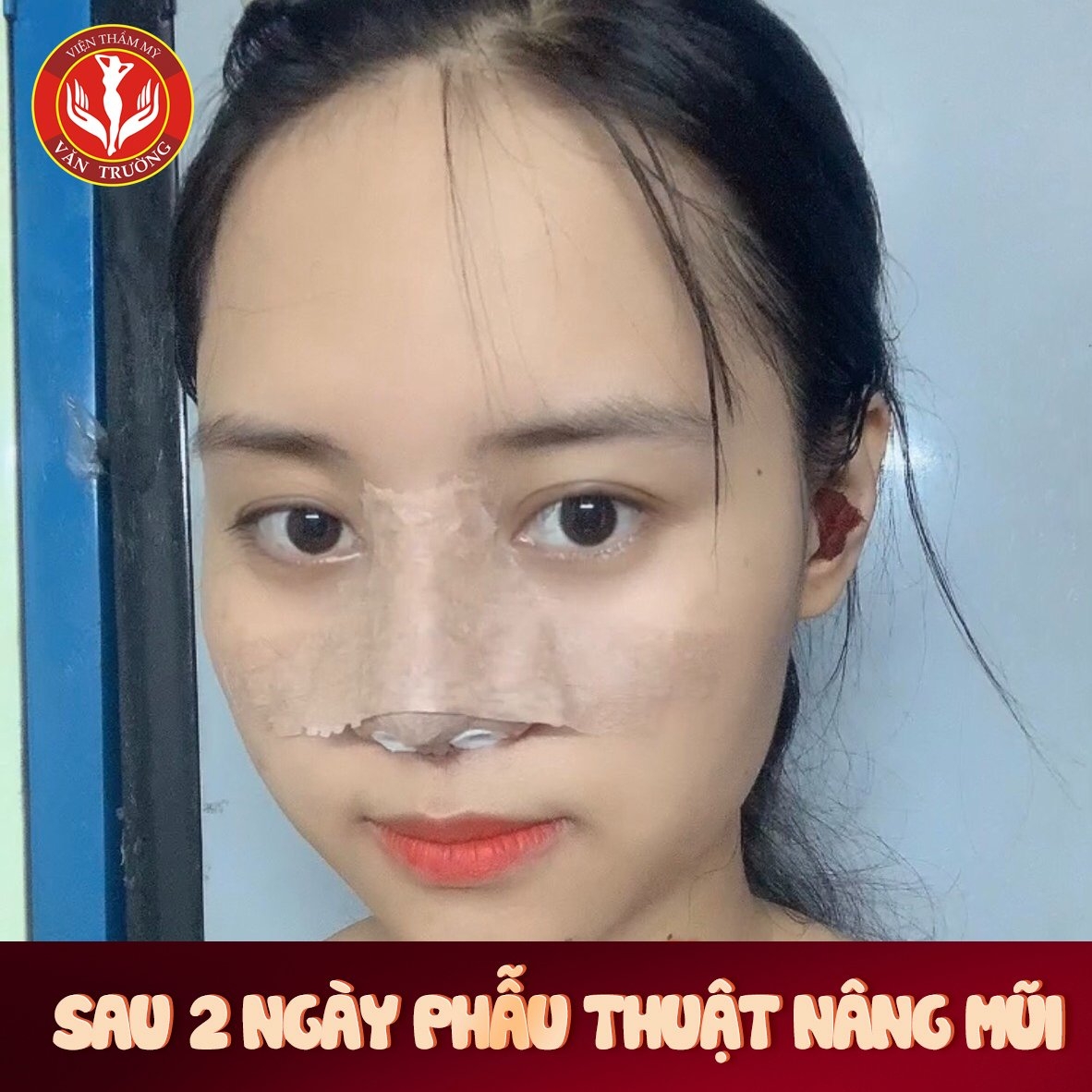Nâng mũi cấu trúc đẹp tại đà nẵng 3