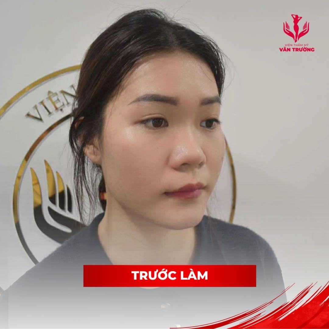 NÂNG MŨI PERFECT 2