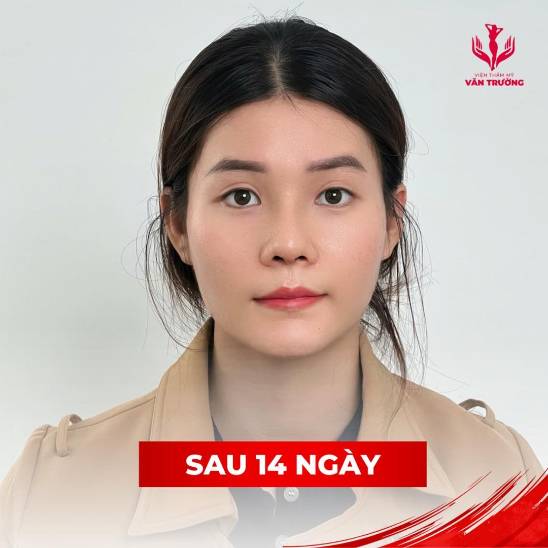 NÂNG MŨI PERFECT 3