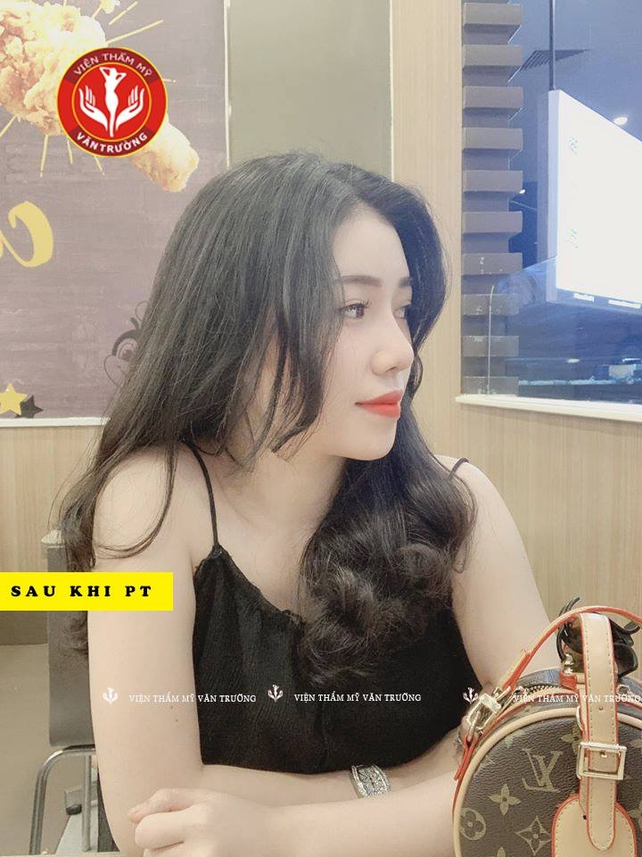 Nâng mũi đẹp tại Đà Nẵng