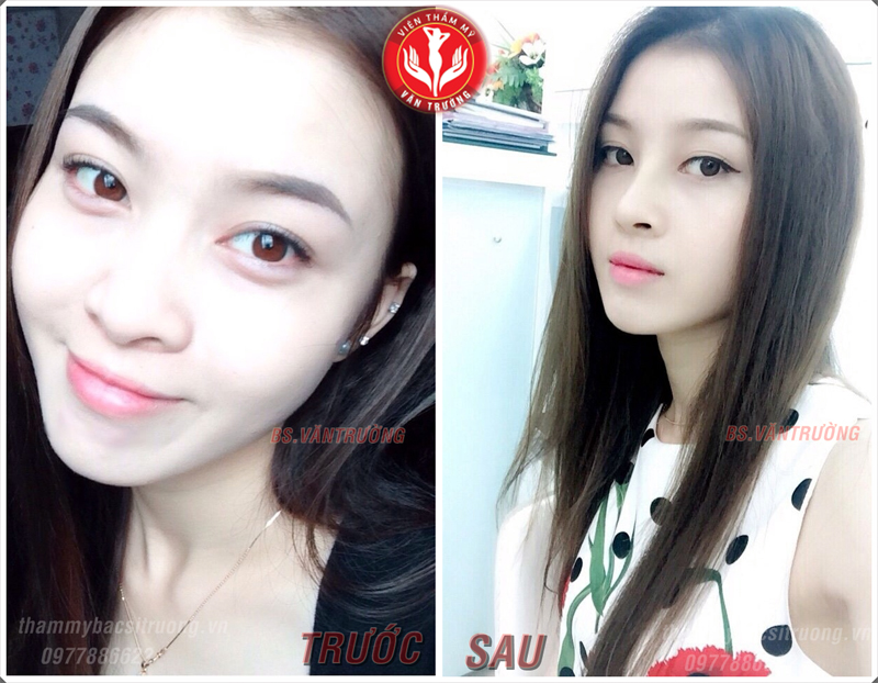 mũi hàn quốc bọc sụn 2