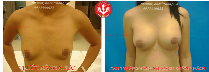 nâng ngực nội soi