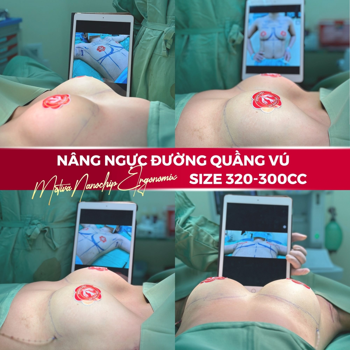 nâng ngực đường quầng vú