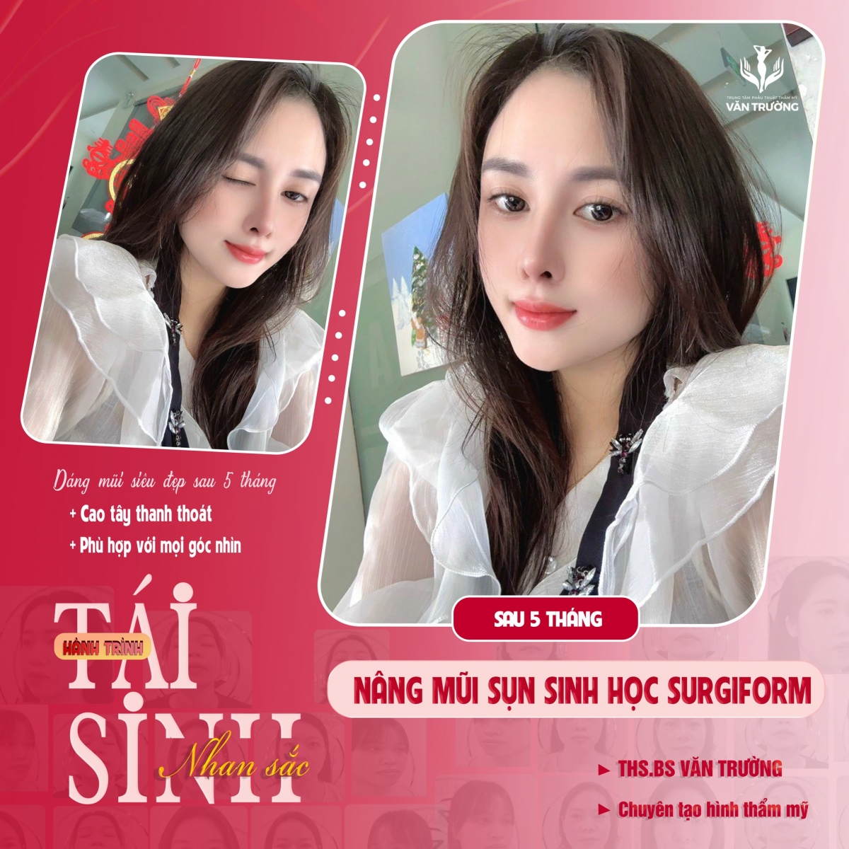 NÂNG MŨI SỤN SINH HỌC SURGIFORM 2