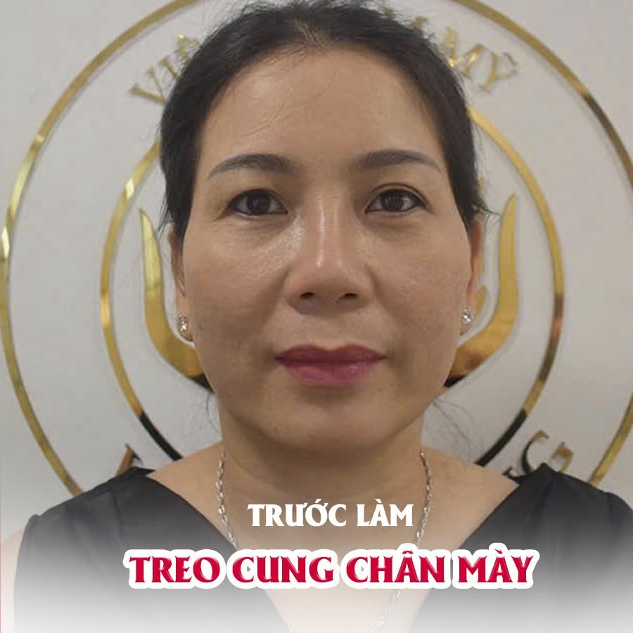 TREO CUNG CHÂN MÀY