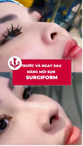 ngay sau nâng mũi