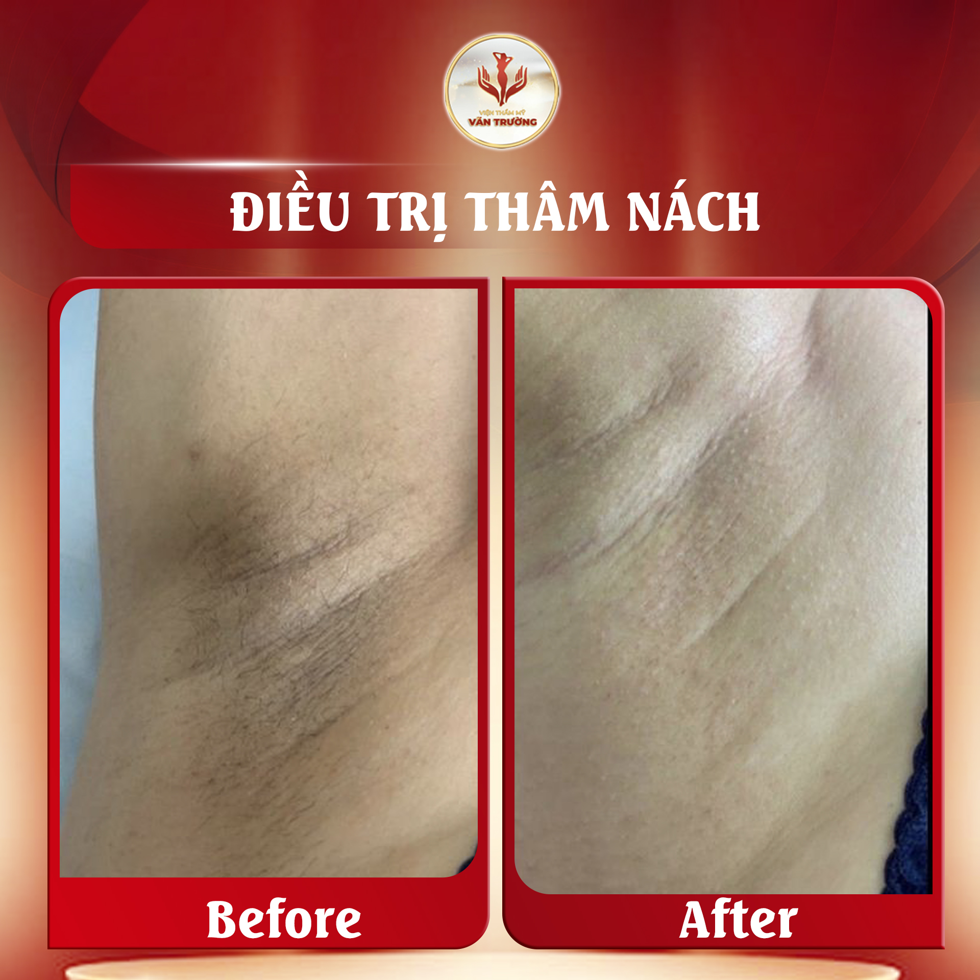 trị thâm nách 1