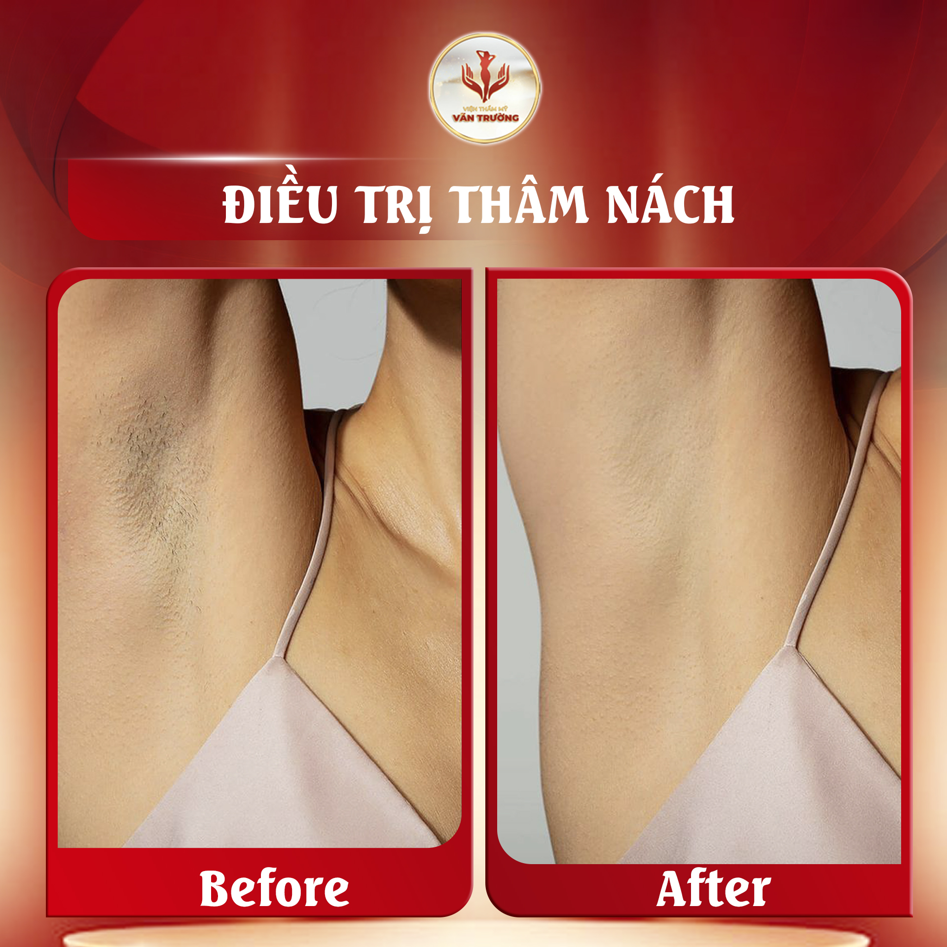 trị thâm nách 3