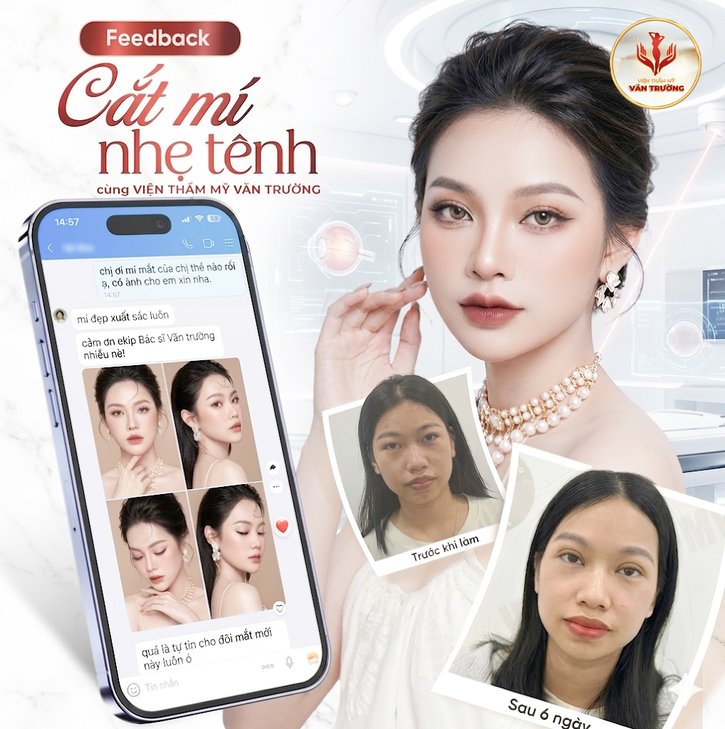 Cắt mí