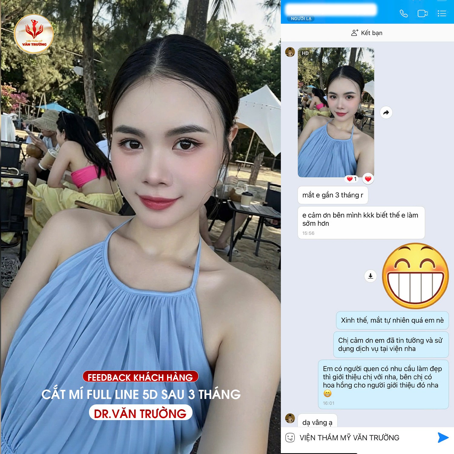 cắt mí đẹp