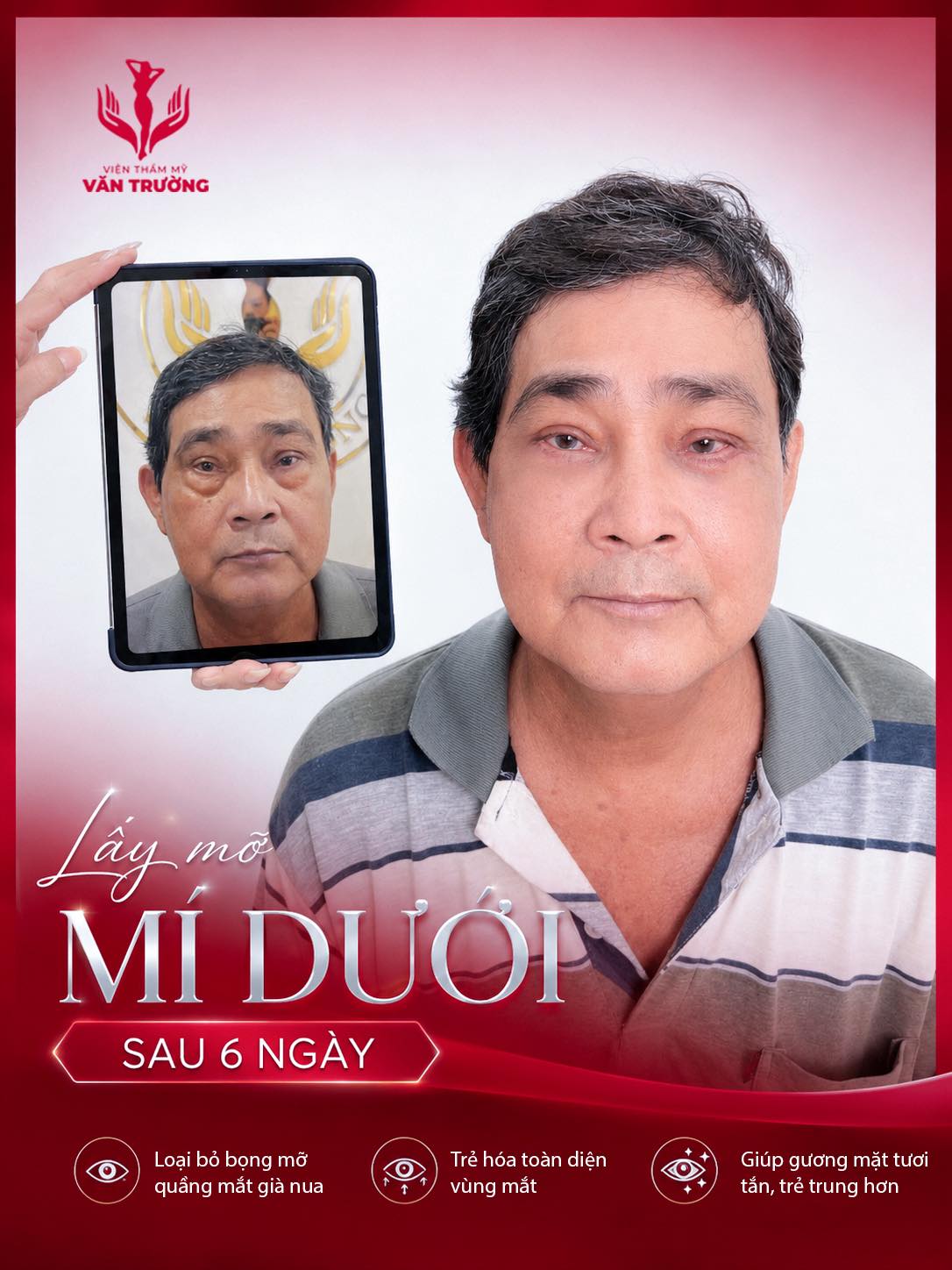 lấy mỡ mi dưới