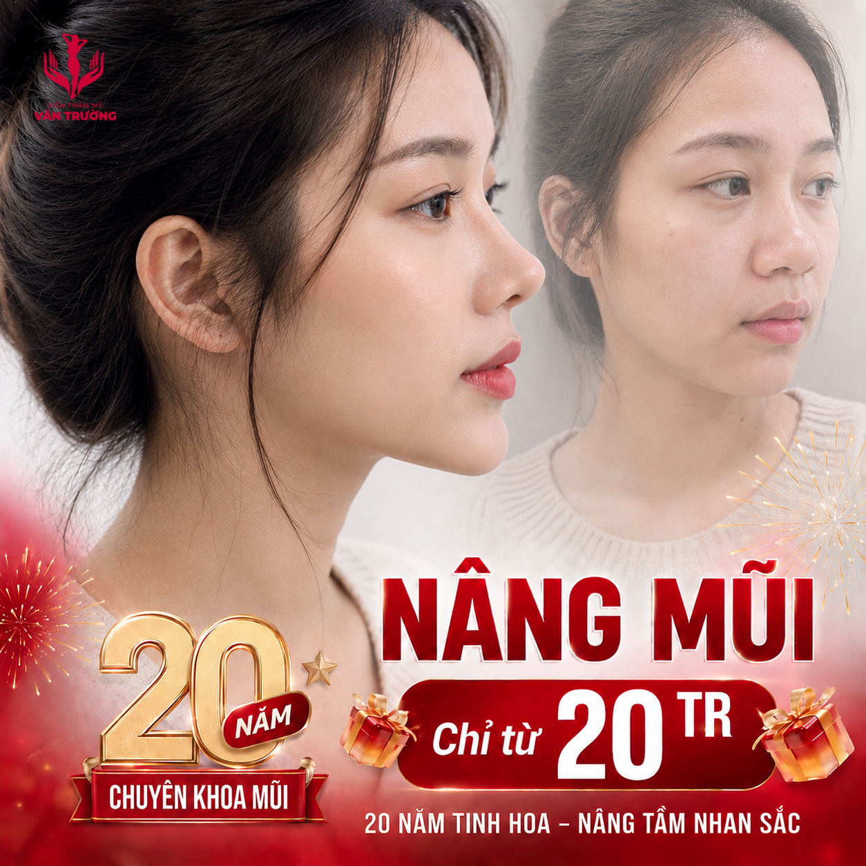 nâng mũi 20 triệu