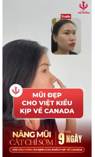 mũi đẹp