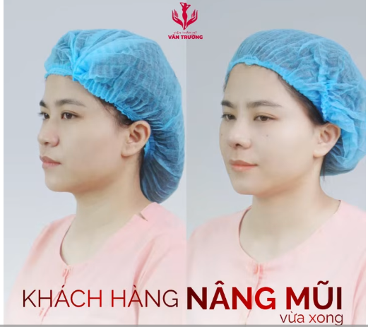 mũi xinh