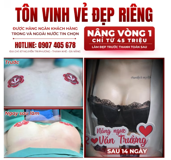 nâng ngực