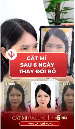 cắt mí fulline 5D