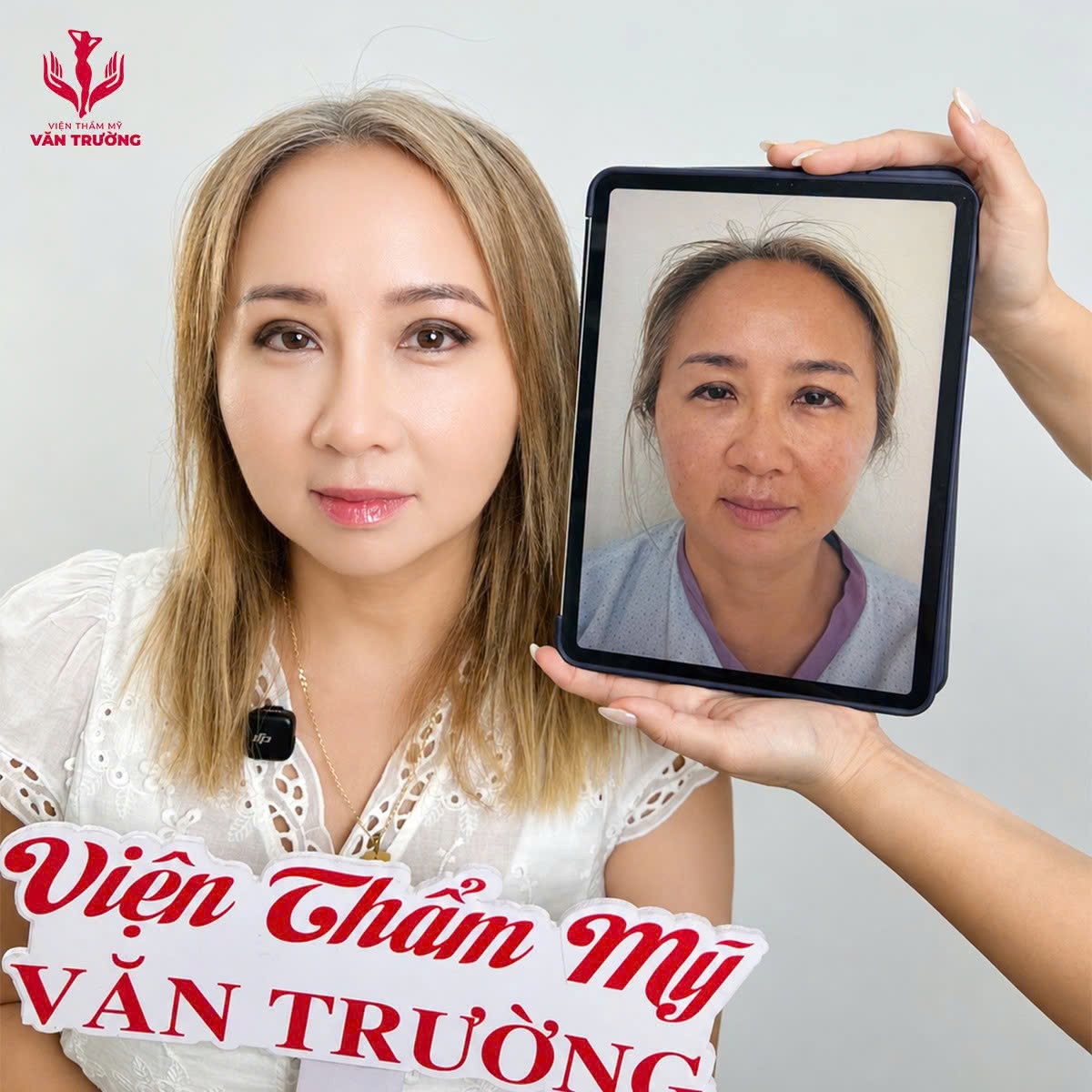 h2 mũi đẹp