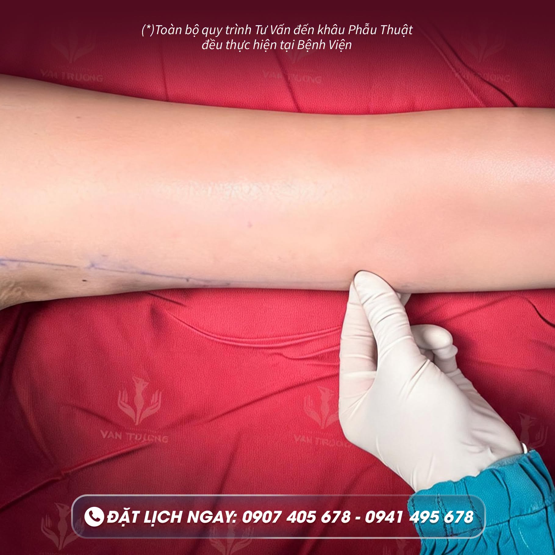 hút mỡ cánh tay 1