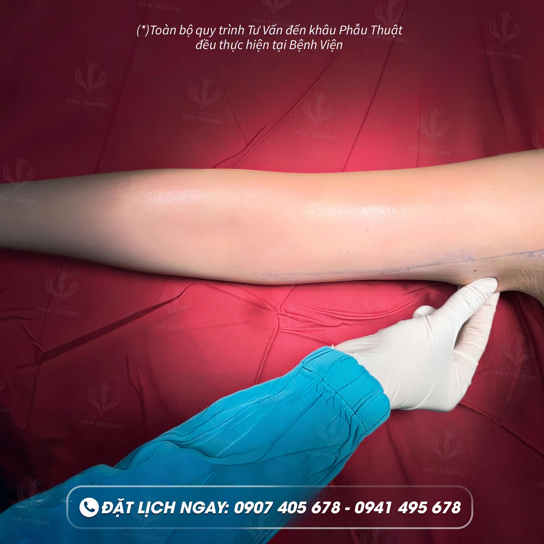hút mỡ cánh tay 3