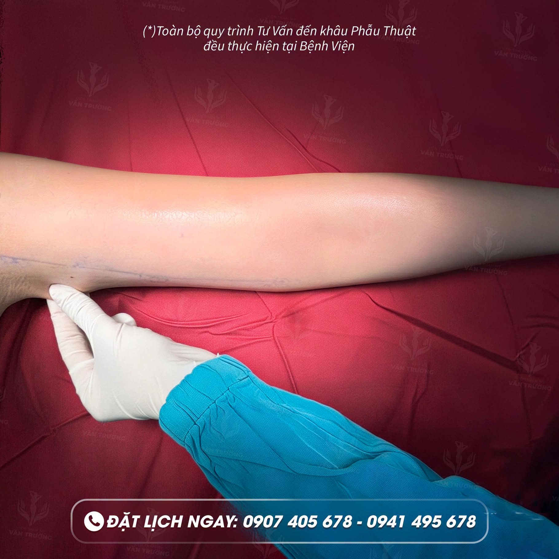 hút mỡ cánh tay 4