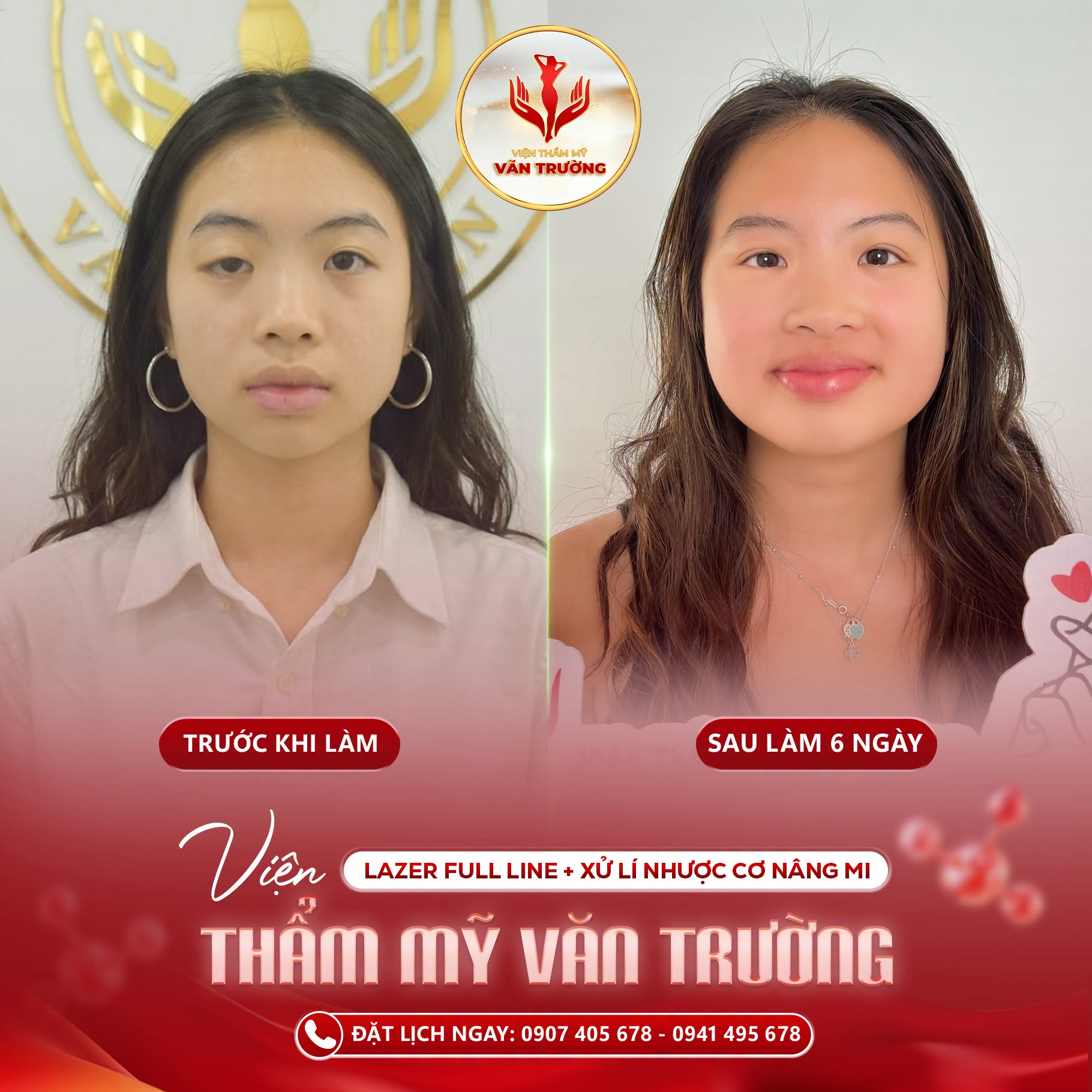 xử lý nhược cơ mi