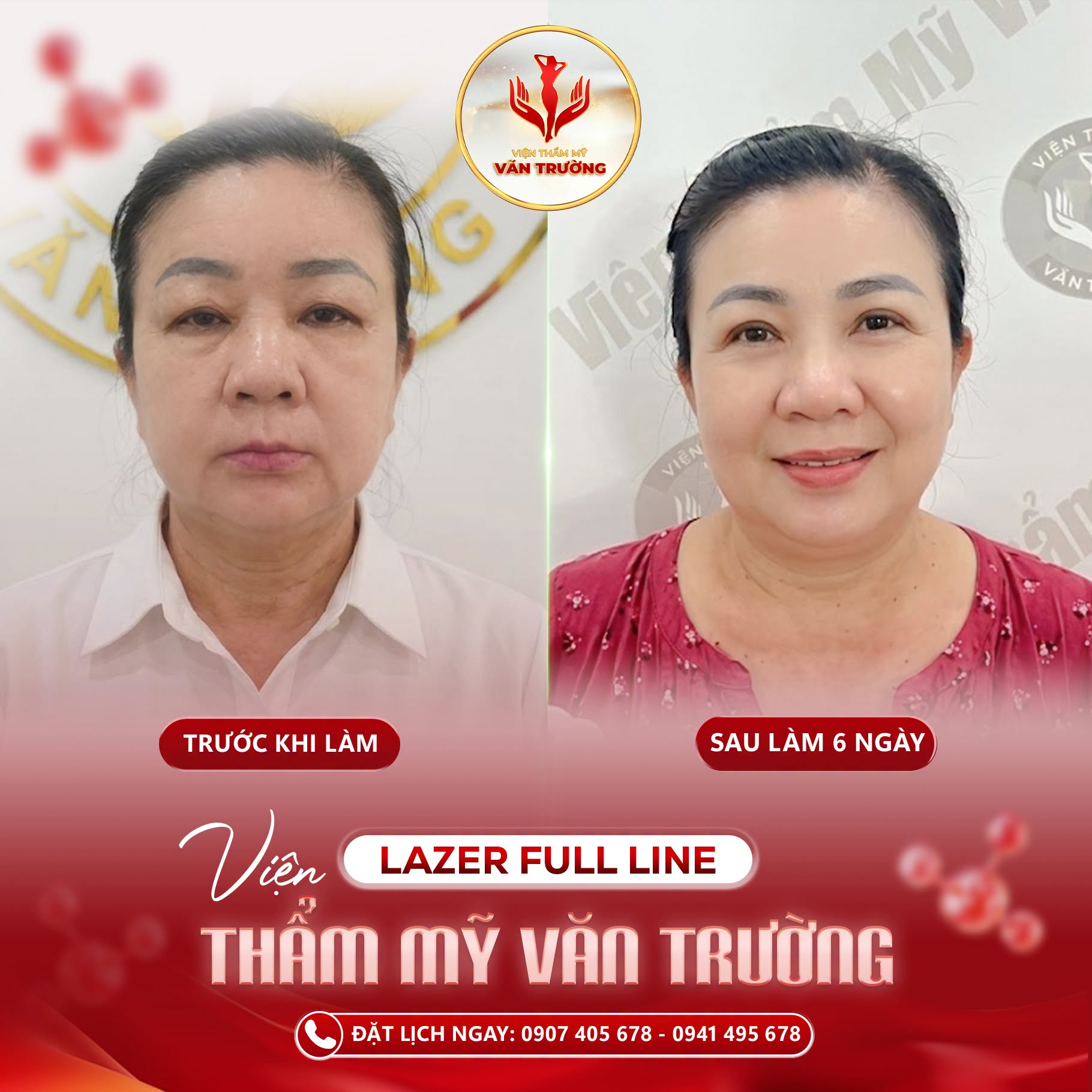 laser full line 5D