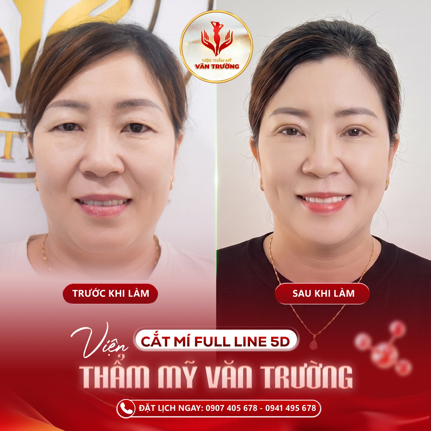 Cắt mí fulline 5D