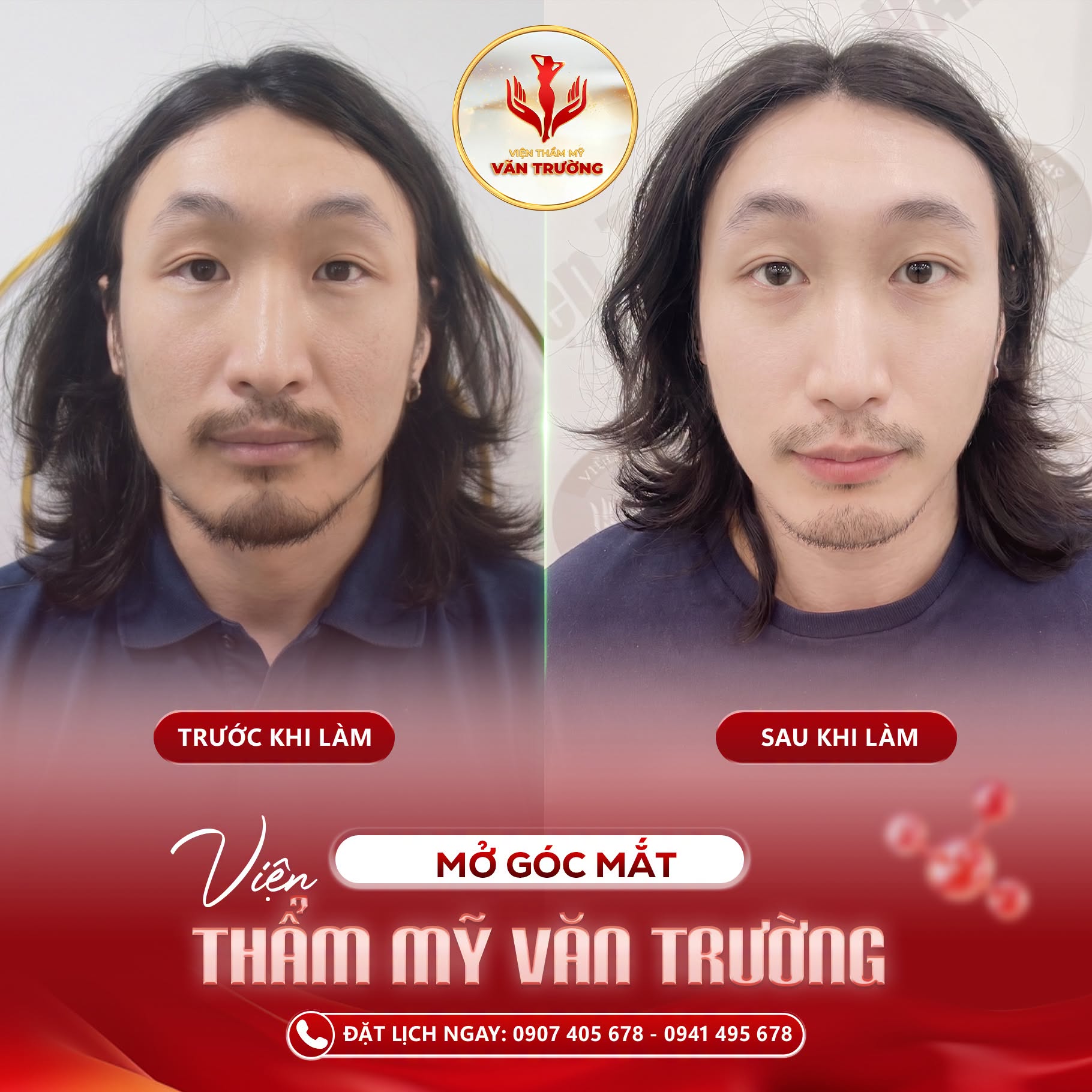 Mở góc mắt